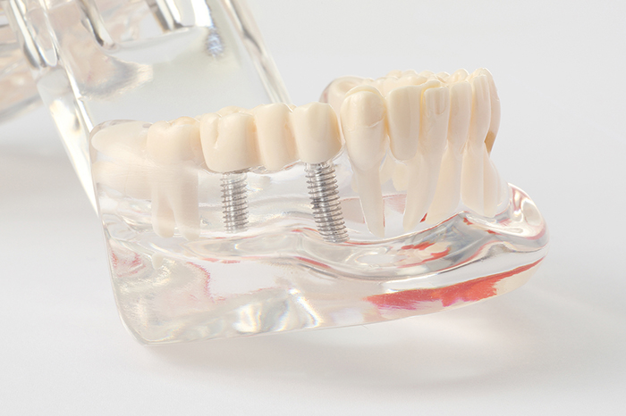 インプラント治療から歯の移植も